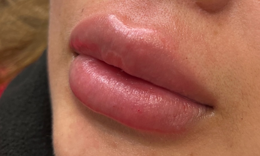 Image 1: Lip Enhancements with 0.5ml or 1ml Filler by UK-Qualified Experts