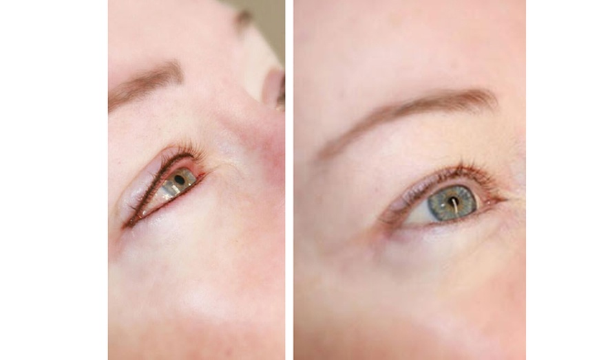 Image 4: Enhance Your Look with HIFU for Neck/Face or Both or Tattoo Eyeliner