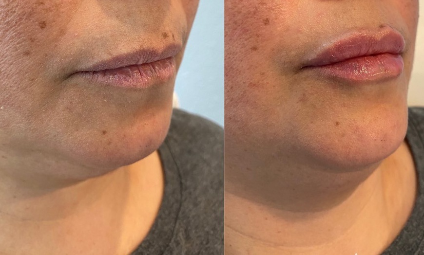 Image 3: Rejuvenate Your Look with 20 or 40 Units of Juveau