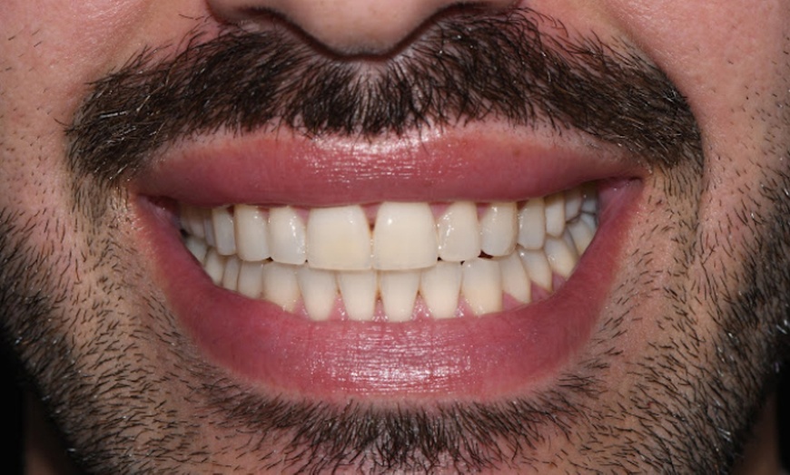 Image 2: Hasta 88% de dto. en Blanqueamiento dental - En consulta - Sin marca en Clínica Dental Sante