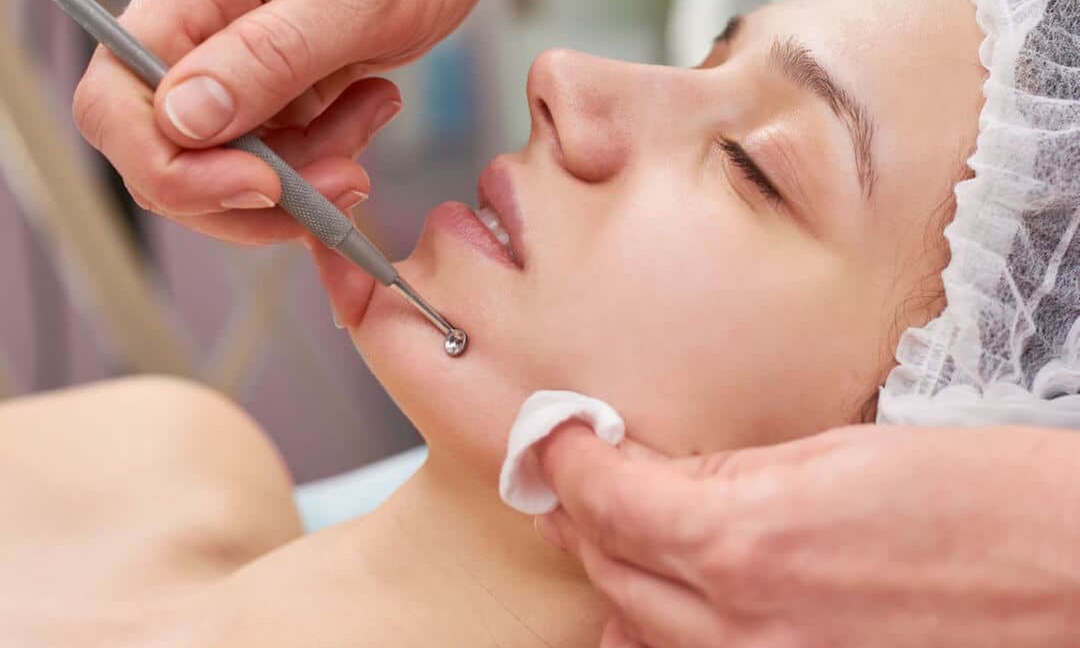 Chemical Peel Treatment