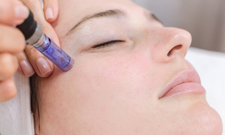 Image 8: Hasta 3 sesiones de microlifting facial de vitaminas con Dermapen