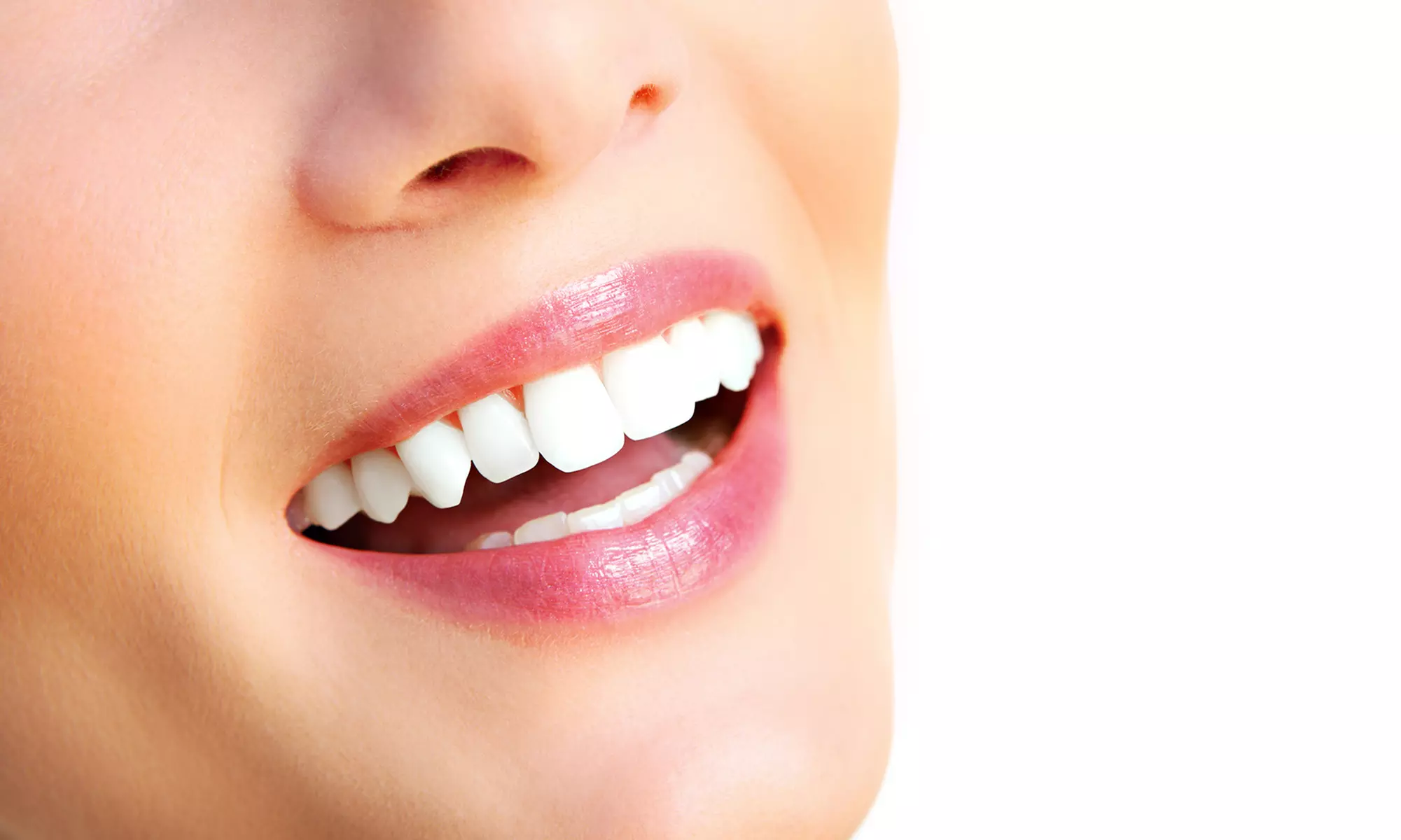 Wybielanie nakładkowe zębów w Dental Bar & Studio wybielania zębów (do -14%) - Primary Image