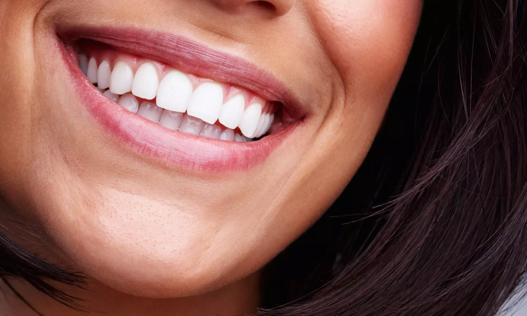 Get Custom Trays and Solution Included with Zoom Teeth Whitening at Spectacular Smiles Dental (Up To 60% Off) - Primary Image