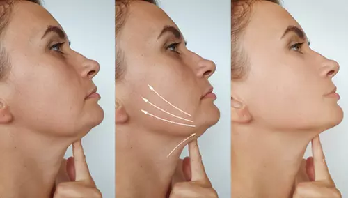 Thread Lift for Mid-Face and Jawline Using PDO Threads