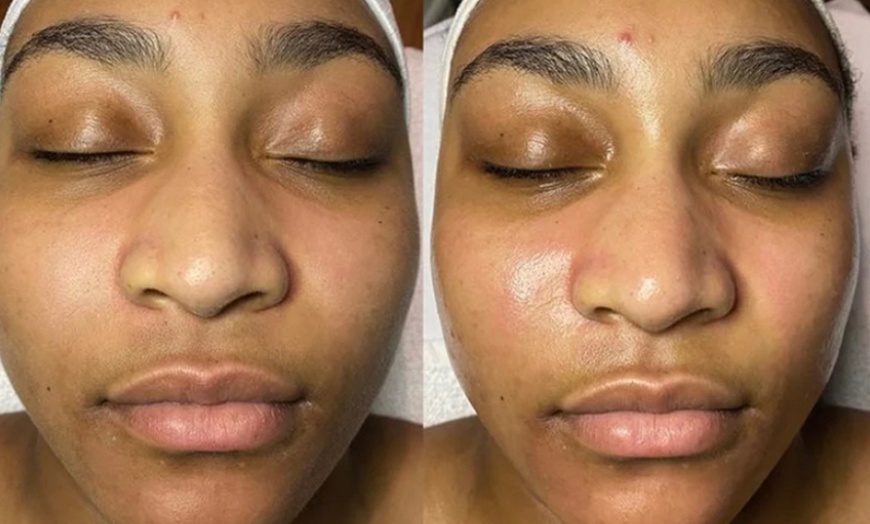 Image 2: Reveal Fresh Skin with One Dermaplane Facial Treatment

