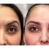 Image 2: Up to 37% Off on Injection - Botox at Metamorph Med Spa