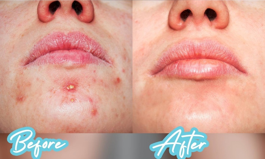 Image 3: Facial - Hydradermabrasion at Paradise aesthetics and nutrition clinic