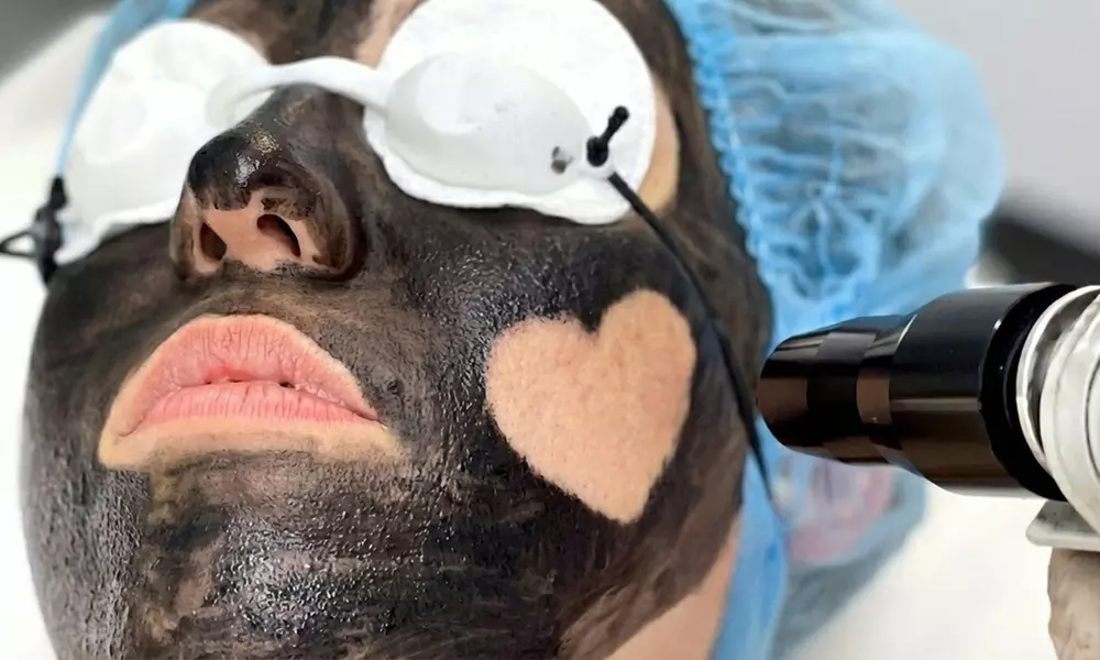 Luxury Carbon Facial – Black Beauty Glow for Radiant, Spotless Skin