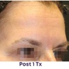 Image 2: Get Opus Plasma Treatment on Forehead, Hands, Face, or Face & Neck 