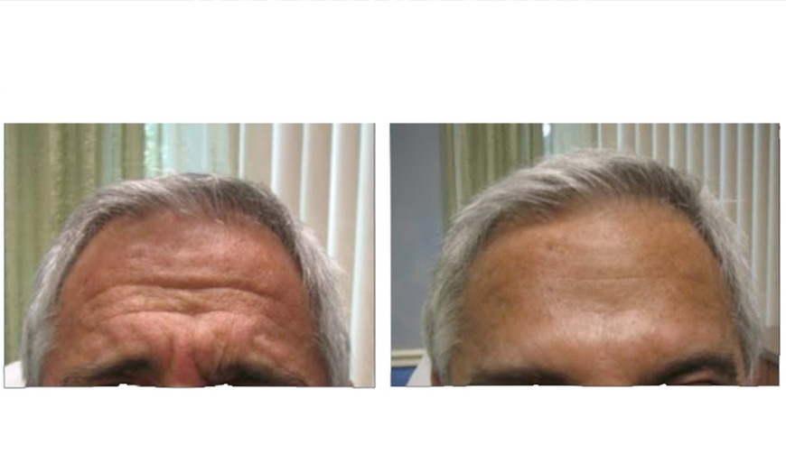 Image 5: Transform your Look with 20,40, or 60 Units of Xeomin 