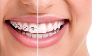 Braces and Invisalign