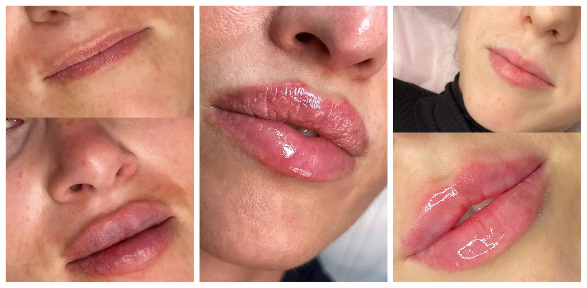 Premium Dermal Filler (REVOLAX®) - 0.5ml or 1ml (Up to 57%Off) - Primary Image