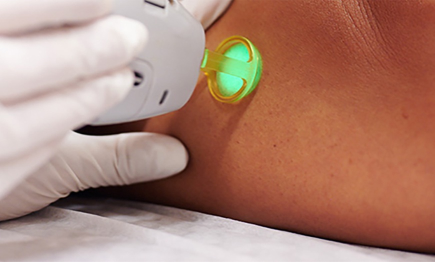 Image 2: Four Laser Hair Removal Sessions