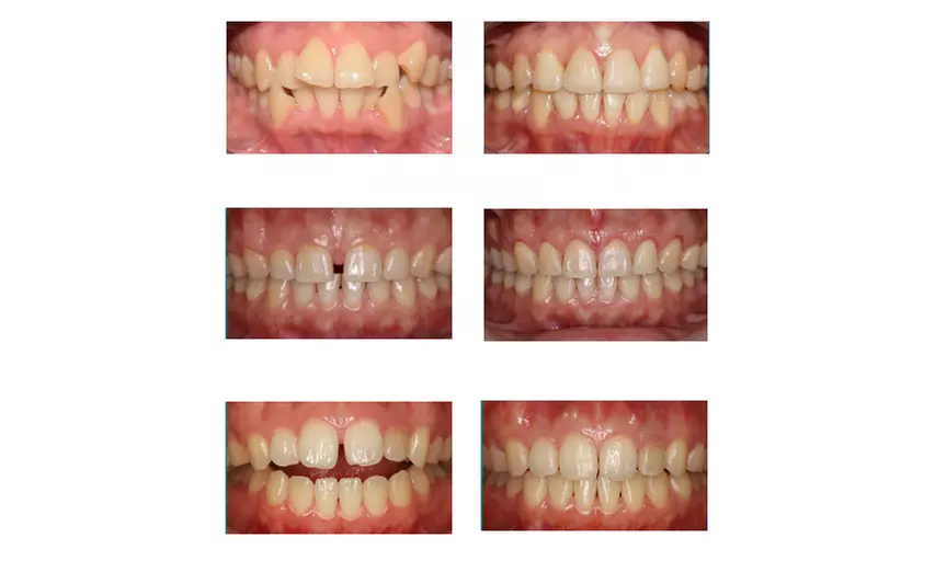Invisalign Consultation for a Complete Smile Transformation