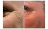 Experience Perfections Body Sculpt's Plasma Fibroblast Treatments for Various Areas, offering up to 75% off