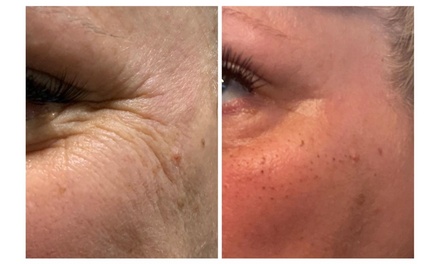 Plasma Fibroblast Skin-Tightening Wrinkle-Removal Treatment on the Frown Lines - Perfections Body Sculpt