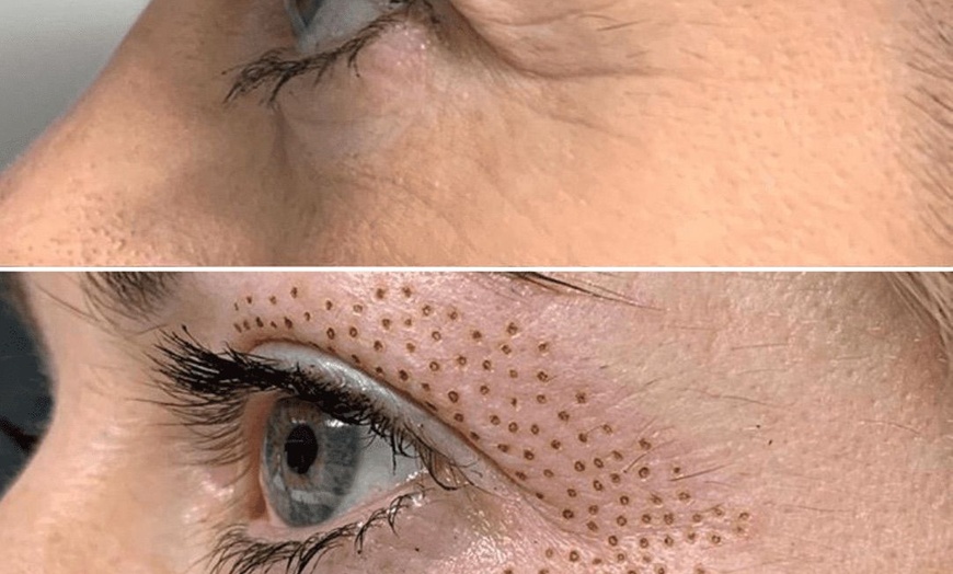 Image 2: Transform Look w/Plasma Pen Upper/Optional Lower Eye Lift