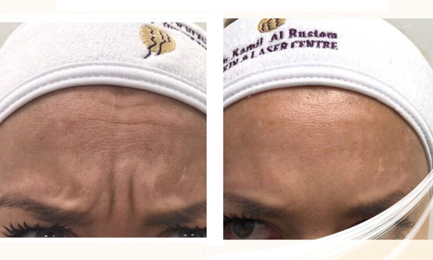 Image 3: Choice of Botox Injections