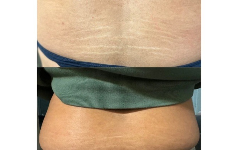 Image 4: Inkless Treatments for Stretch Marks & Scars on Various Body Areas