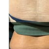 Image 4: Inkless Treatments for Stretch Marks & Scars on Various Body Areas