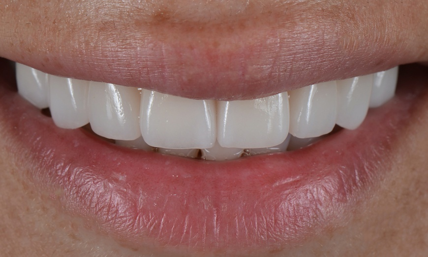 Image 1: Composite Bonding with Whitening at Poynton Dental Practice