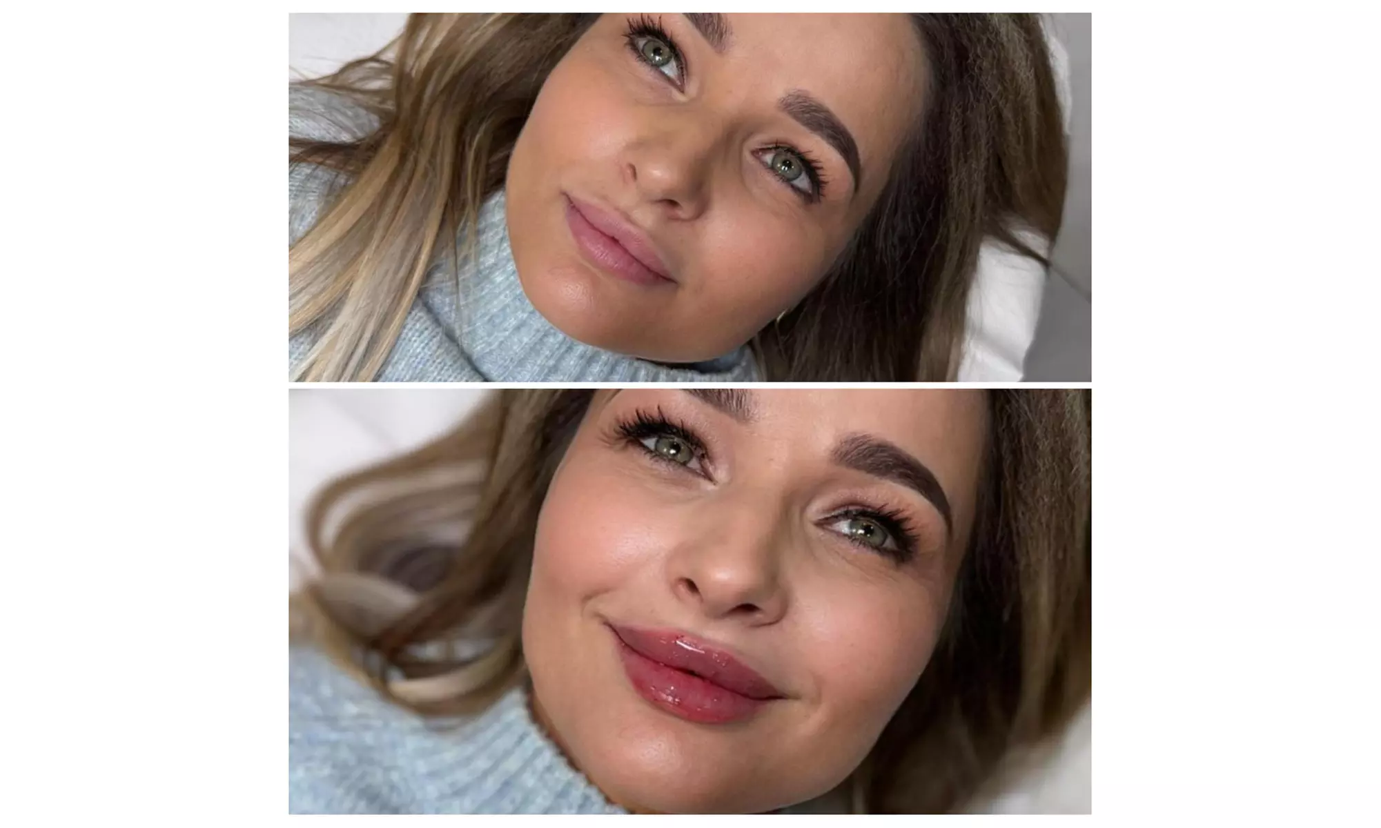 Premium Dermal Filler (REVOLAX®) - 0.5 or 1ml (Up to 57%Off)