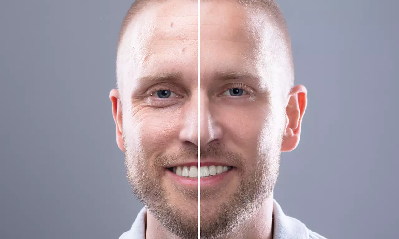 Up to 50% Off on Radiofrequency microneedling at A Beauty By Design