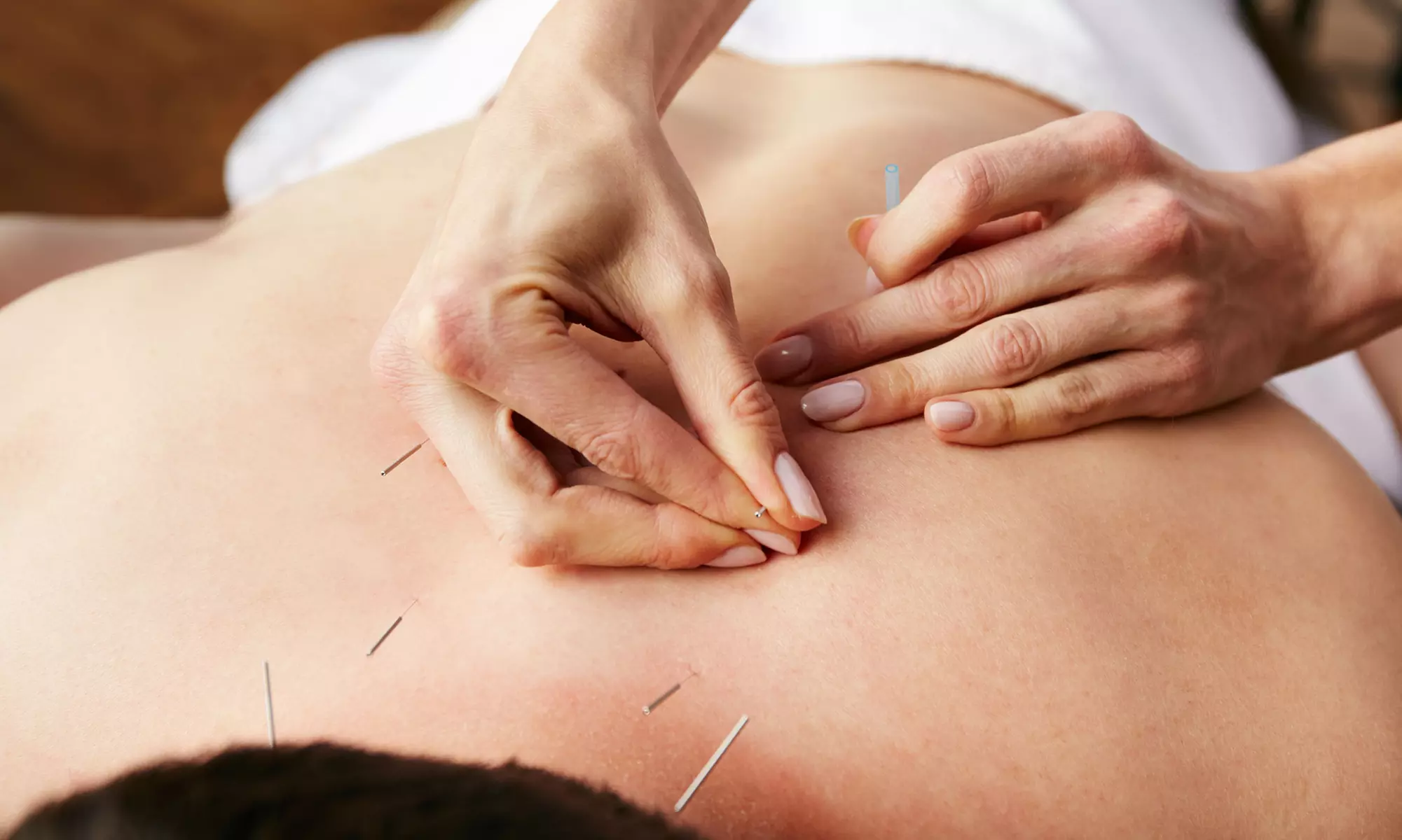 Explore Life Tree Wellness Center's acupuncture services, from traditional to facial rejuvenation, with up to 50% off. - Primary Image