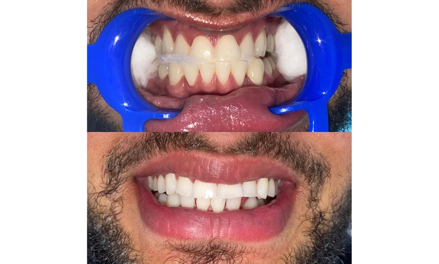 Image 3: Teeth Whitening Treatment