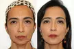 Non Surgical Face Lift w/w/o Advanced Skin Tightening & Jawline Sculpting at Your Sculpt Studio (Up to 50% Off) - Image 4