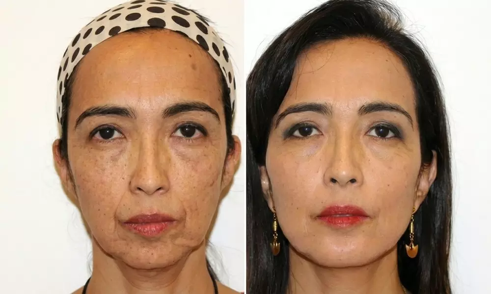 Non Surgical Face Lift w/w/o Advanced Skin Tightening & Jawline Sculpting at Your Sculpt Studio (Up to 50% Off)
