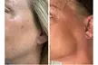 1, 2, or 3 IPL Photo Facials at Laser Options by Jen LLC for Redness, Pigmentation & Fine Lines (Up to 60% Off) - Second Medium