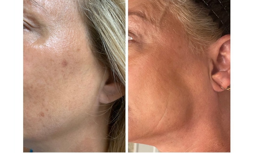 Image 5: 1, 2, or 3 IPL Photo Facials to Target Redness, Pigmentation & Texture