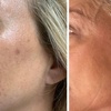 Image 5: 1, 2, or 3 IPL Photo Facials to Target Redness, Pigmentation & Texture