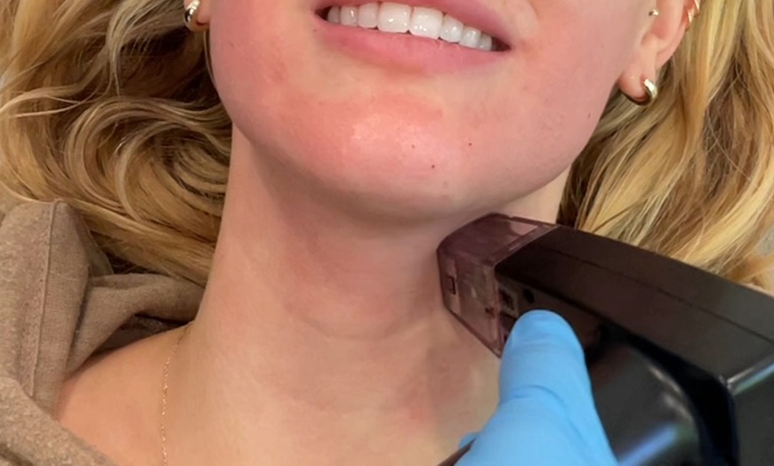 Image 2: Achieve Smooth Skin with Morpheus 8 and Light Therapy