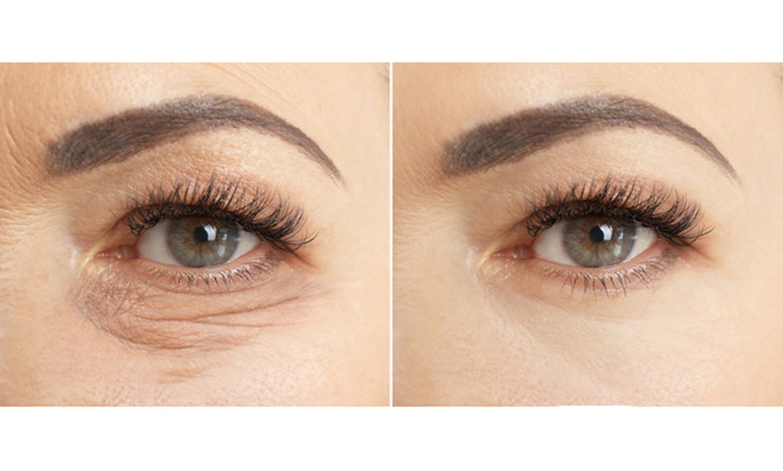 Image 6: Advanced Skin Regeneration with 1,2,or 3 Sessions of Polynucleotide 