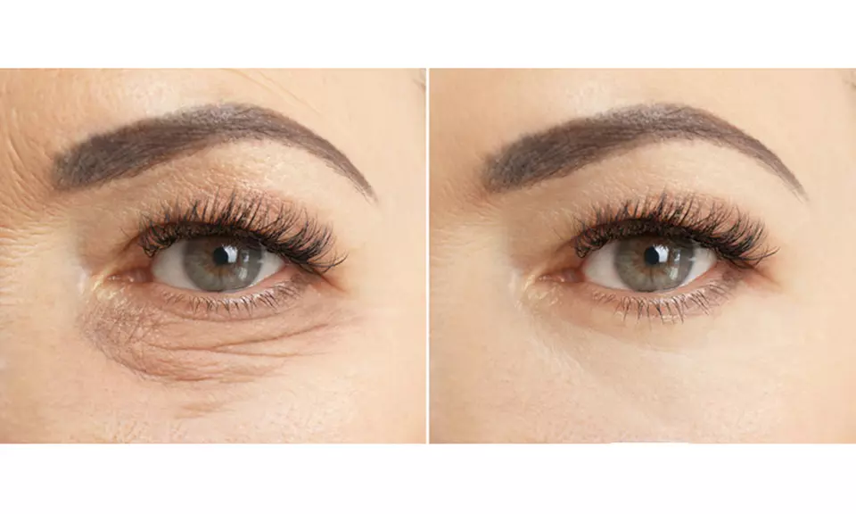 Advanced Skin Regeneration with 1,2,or 3 Sessions of Polynucleotide