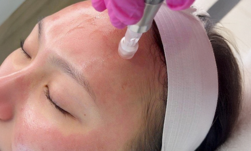 Image 1: Gesichtsbehandlung mit Microneedling, Gel-Reinigung oder Ultraschall für 1 Person (bis zu 50% sparen)