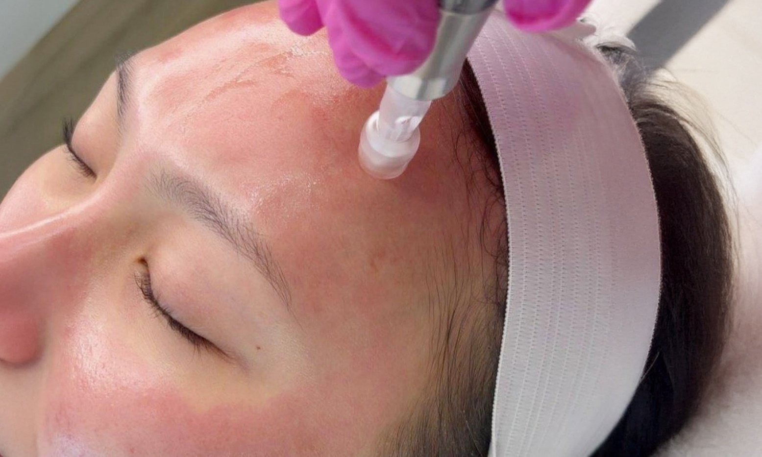 Gesichtsbehandlung mit Microneedling, Gel-Reinigung oder Ultraschall für 1 Person (bis zu 50% sparen)