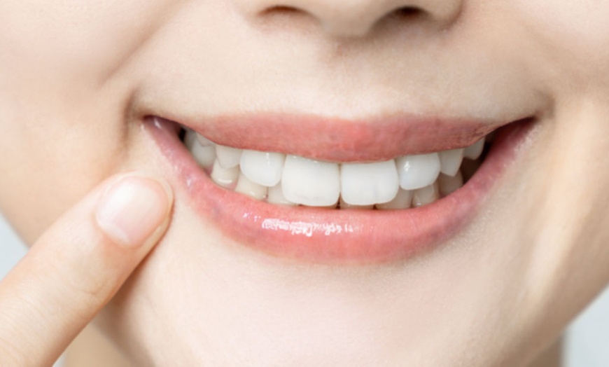 Image 2: Checkup, Scale, and Polish or Teeth Whitening with In-Home Trays