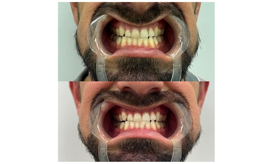 Image 2: Get Premium 60-Min Teeth Whitening For 1 or 2 People For Bright Smile 