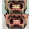 Image 2: Get Premium 60-Min Teeth Whitening For 1 or 2 People For Bright Smile 