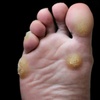 Image 1: Step Smoothly: Renew Your Feet with Expert Callus Removal!