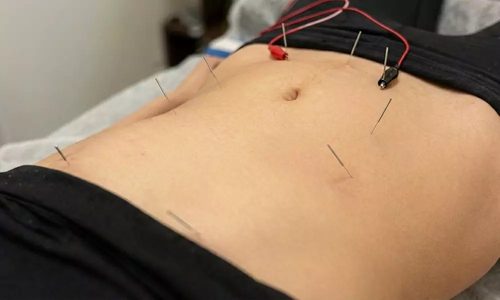 Yoo Balance Therapy & Wellness Offers 1, 3, or 5 Sessions of Acupuncture for Holistic Wellness (Up to 60% Off)