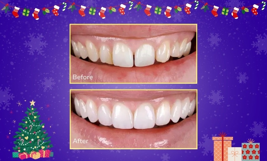 Image 4: Transform Your Smile with Custom Teeth Whitening