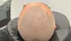 2 or 4 Hour Scalp Micropigmentation for Hairline, Crown or Full Scalp Restoration at Authentic SMP(Up to 33%Off)