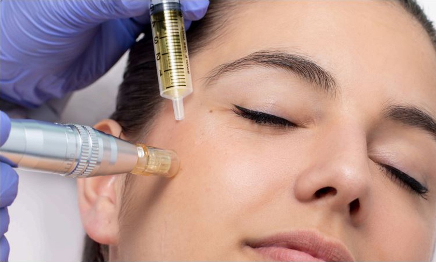 Image 1: Regenera tu piel con 1 o 2 sesiones de exosomas con dermapen 