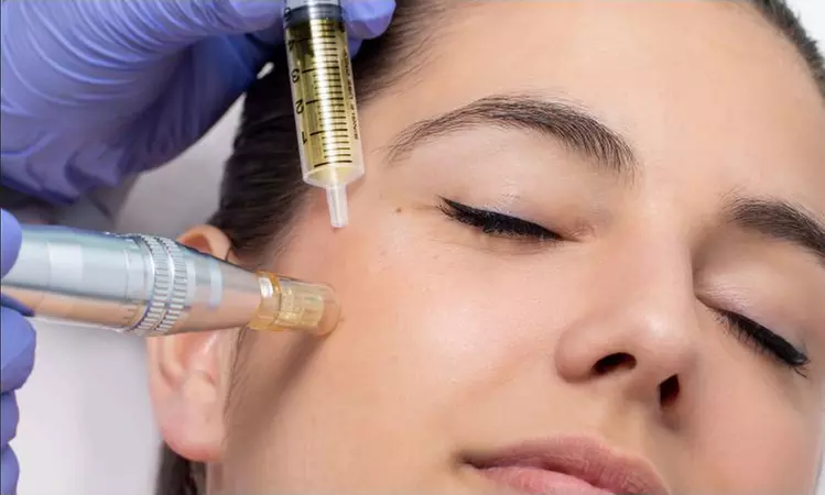 Regenera tu piel con 1 o 2 sesiones de exosomas con dermapen