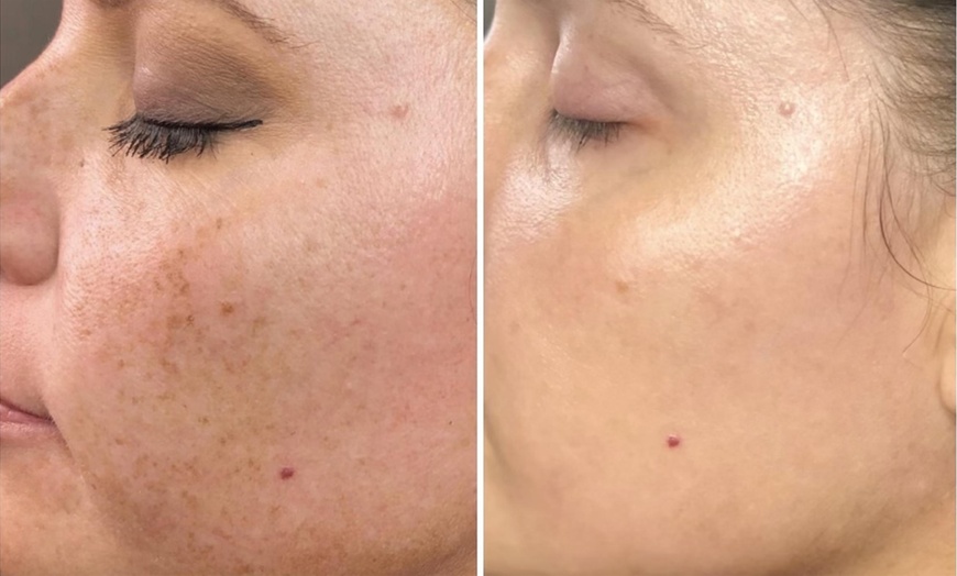 Image 4: 1 o 3 sesiones de IPL facial para revitalizar o atenuar manchas